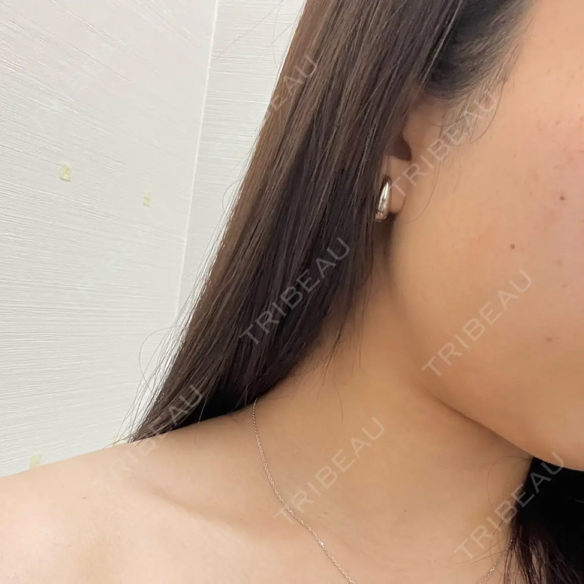 ボトックス（エラ・小顔） TCB東京中央美容外科 高田馬場院 AFTER