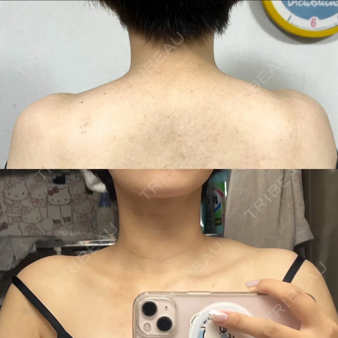 ボトックス（肩） DMTC美容皮膚科 大宮院 AFTER
