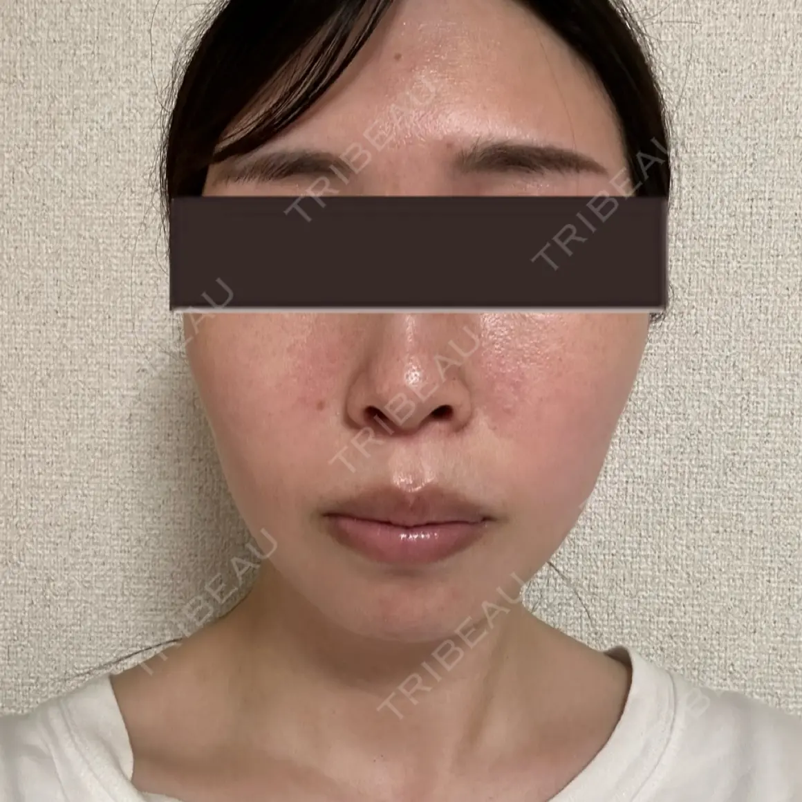 ボトックス（あご） / ヒアルロン酸注入（あご） / ヒアルロン酸注入（唇） / ボトックス（口角） / ボトックス（人中） / ヒアルロン酸注入（鼻翼基部） EMMO FACE CLINIC 大宮院 AFTER