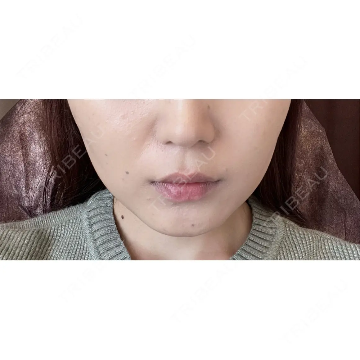 ボトックス（あご） / ヒアルロン酸注入（あご） / ボトックス（エラ・小顔） / ヒアルロン酸注入（唇） THE FIRST CLINIC 町田院 AFTER