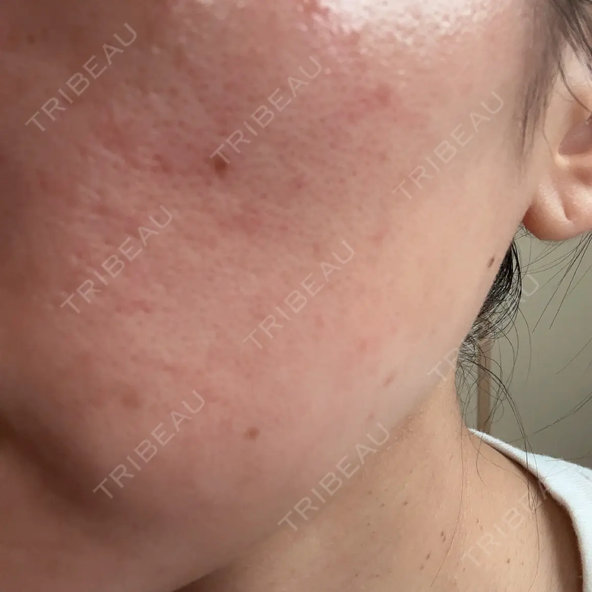 その他（肌） PRISM Beauty Clinic AFTER