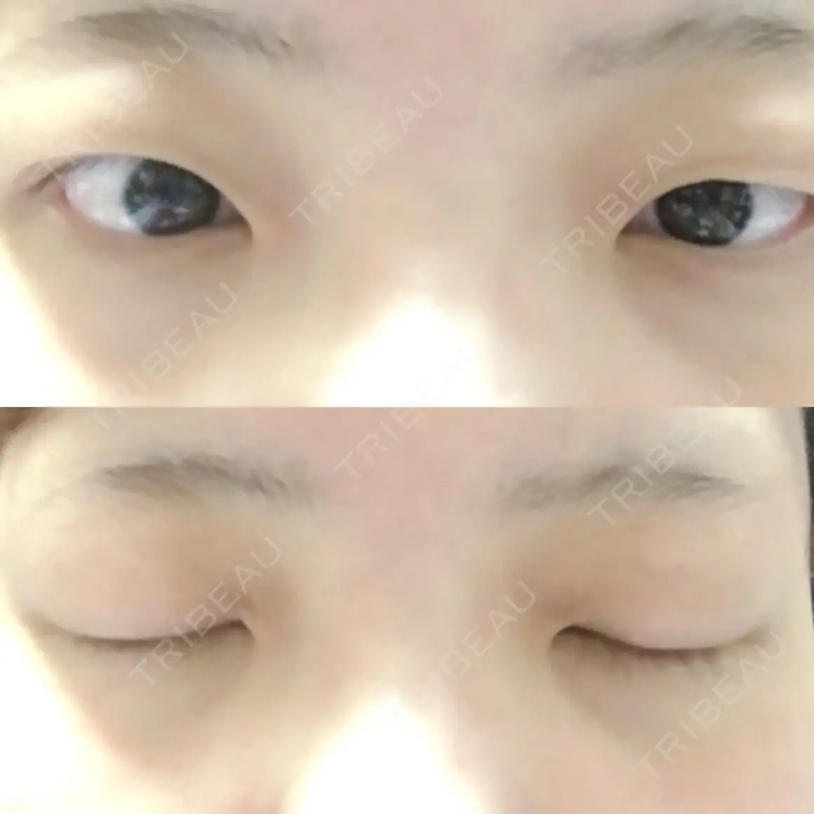 二重切開 TANAKAクリニック形成外科・美容外科 AFTER