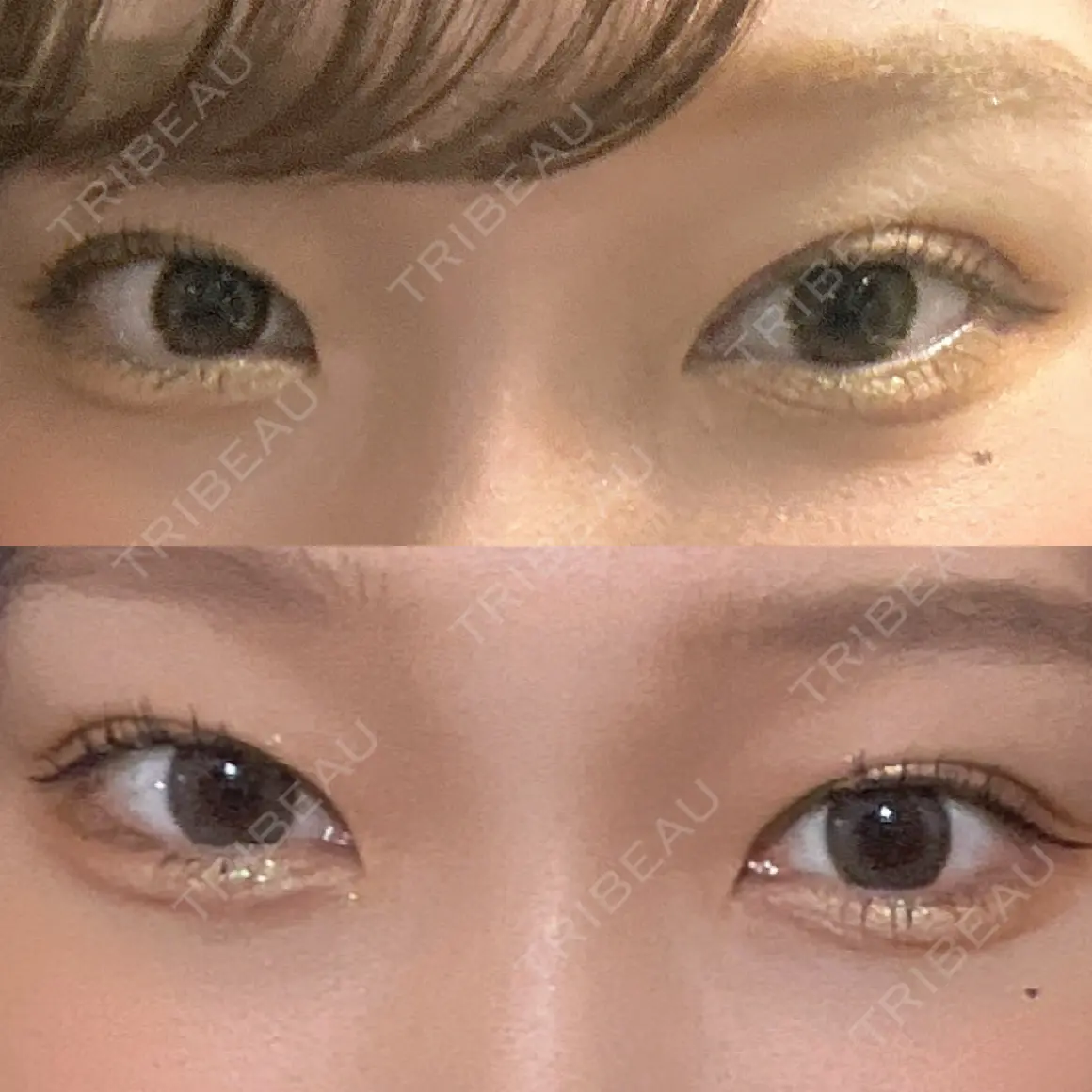 二重埋没 東京シンデレラ美容外科 大宮院 AFTER