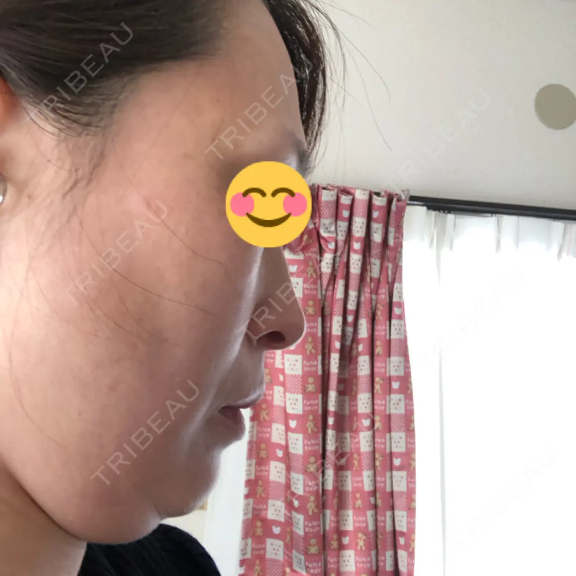 脂肪吸引注射（顔） 湘南美容クリニック 甲府院 AFTER