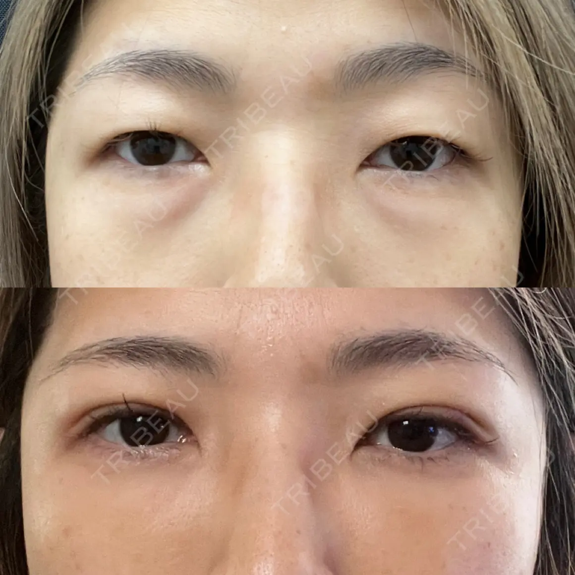 二重埋没 / 下まぶたの脂肪取り / 脂肪注入（目の下） 湘南美容クリニック 西葛西院 AFTER