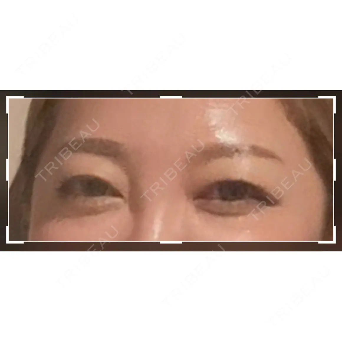 二重埋没 / 上まぶたの脂肪取り ROOTS Clinic AFTER
