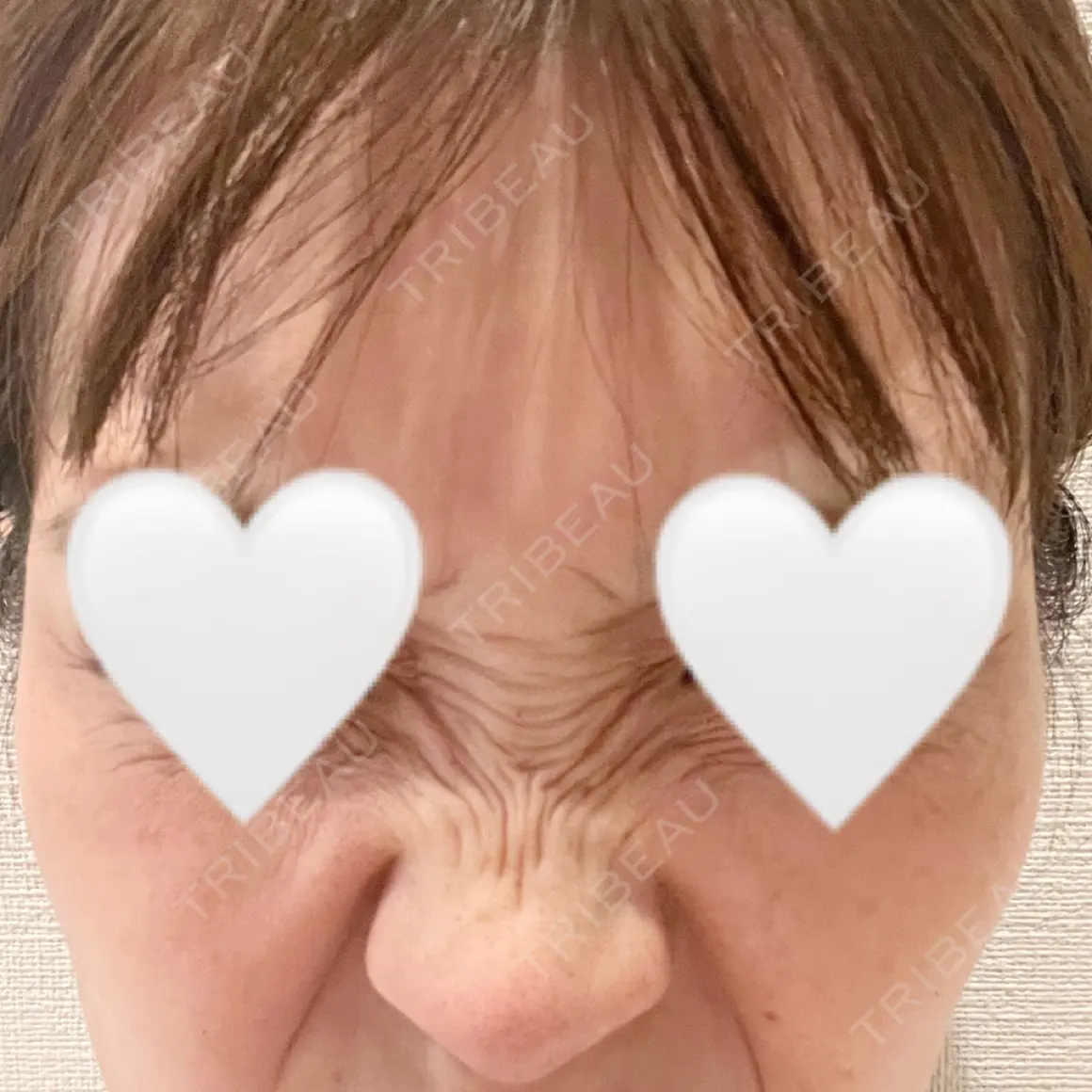 ボトックス（口角） / ボトックス（眉間） / ボトックス（目尻） / その他（鼻） WellnessPlus Clinic 【ウェルネスプラスクリニック】 AFTER