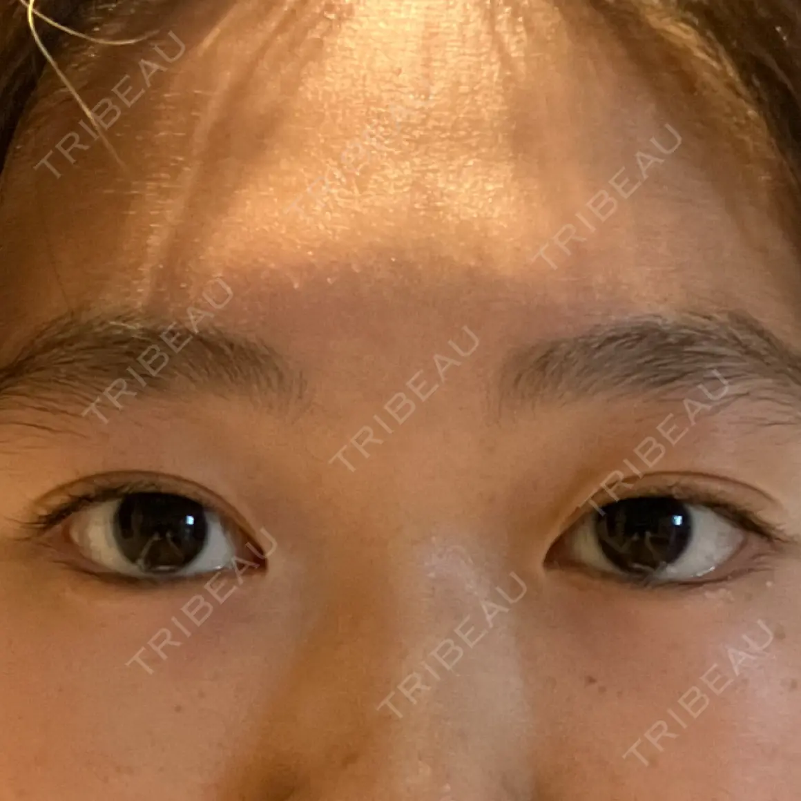 二重埋没 湘南美容クリニック 西葛西院 AFTER