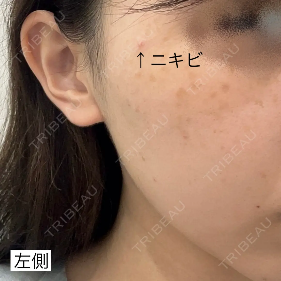 光治療（フォトフェイシャルなど） 湘南美容クリニック 銀座院 AFTER