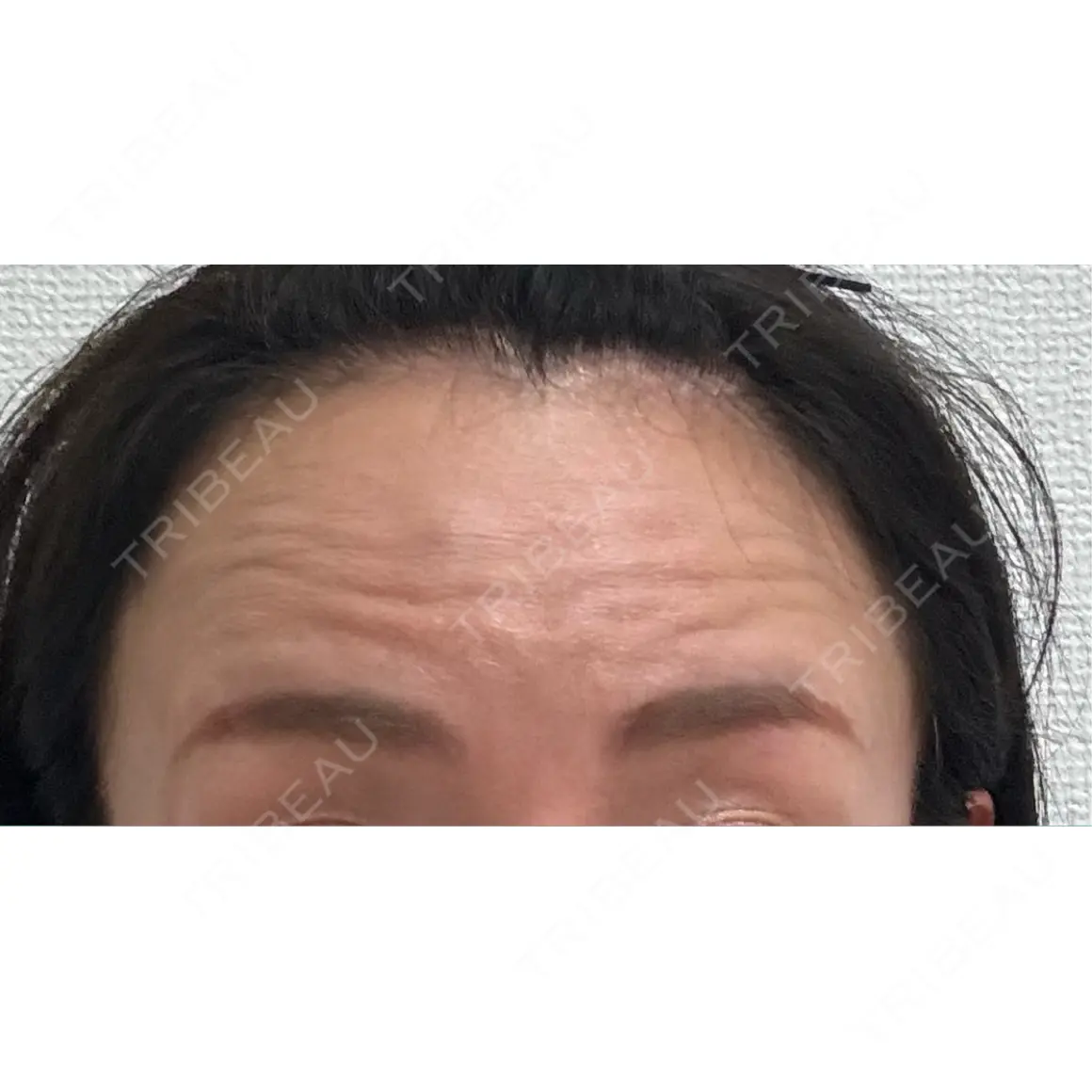 ボトックス（額） WellnessPlus Clinic 【ウェルネスプラスクリニック】 AFTER
