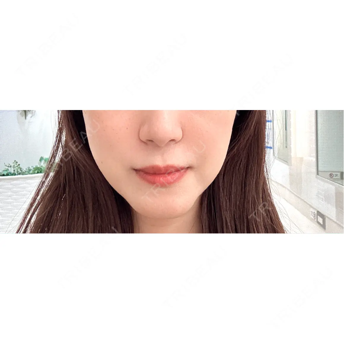 ヒアルロン酸注入（あご） ルラ美容クリニック 町田院 AFTER