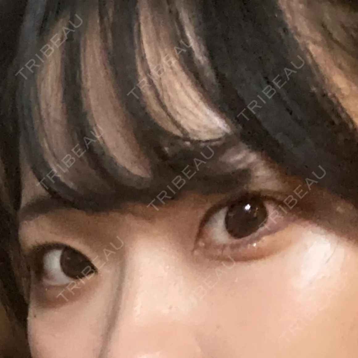 ヒアルロン酸注入（涙袋） Code Beauty Clinic 名古屋院 AFTER