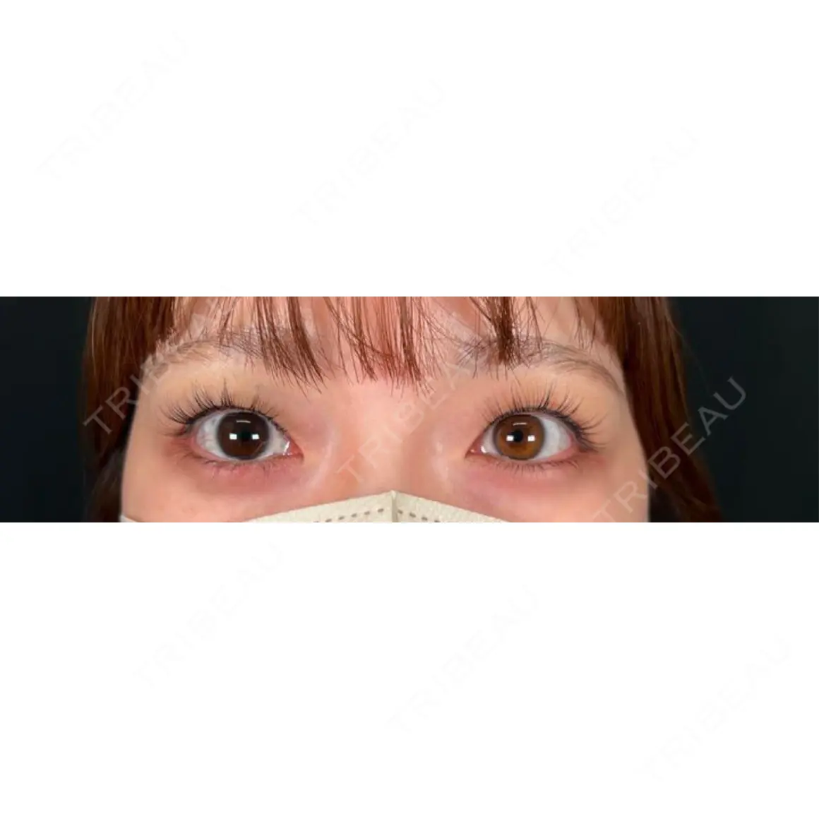 二重埋没 湘南美容クリニック 西葛西院 AFTER