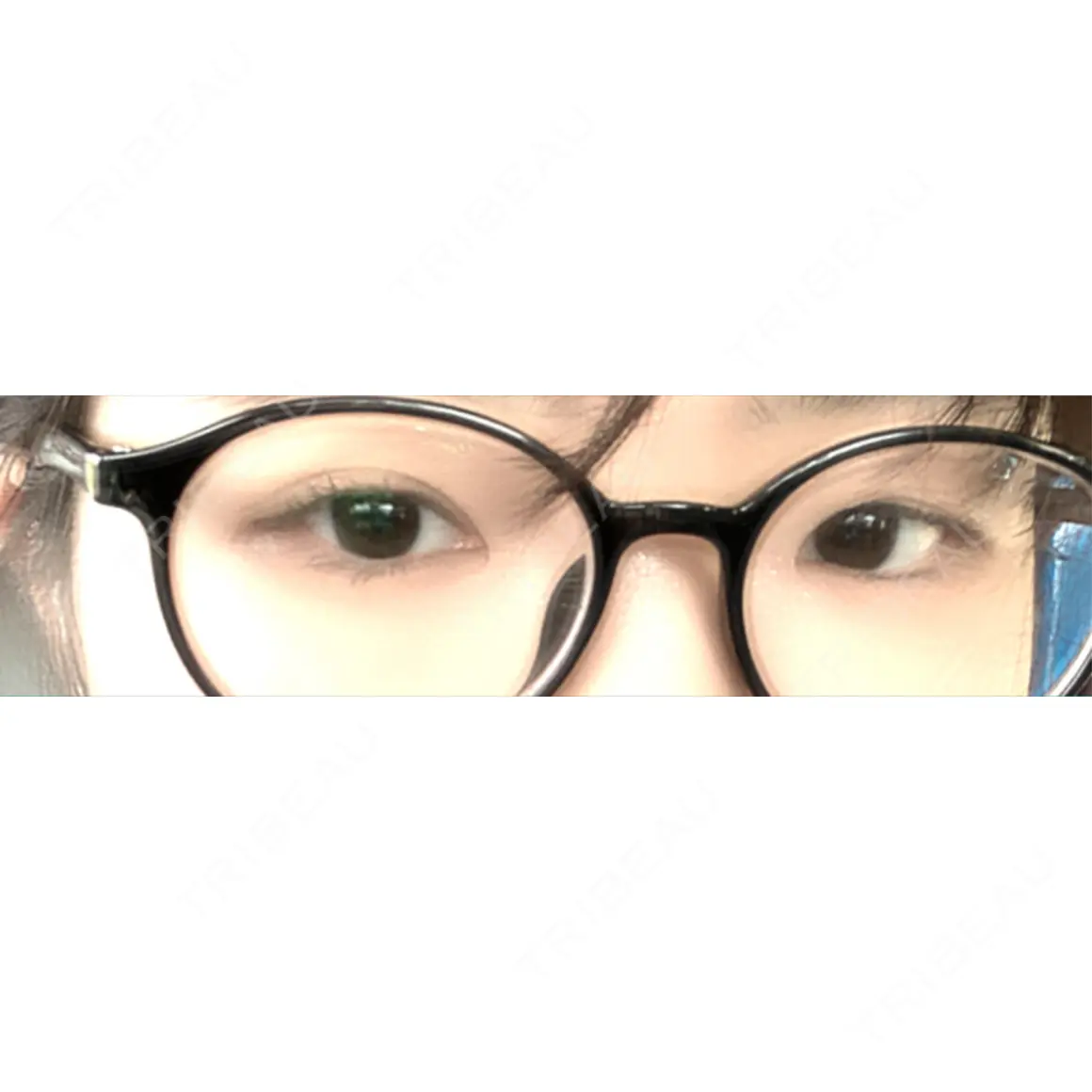 二重埋没 BELINDA CLINIC（ベリンダクリニック）岡山院 AFTER
