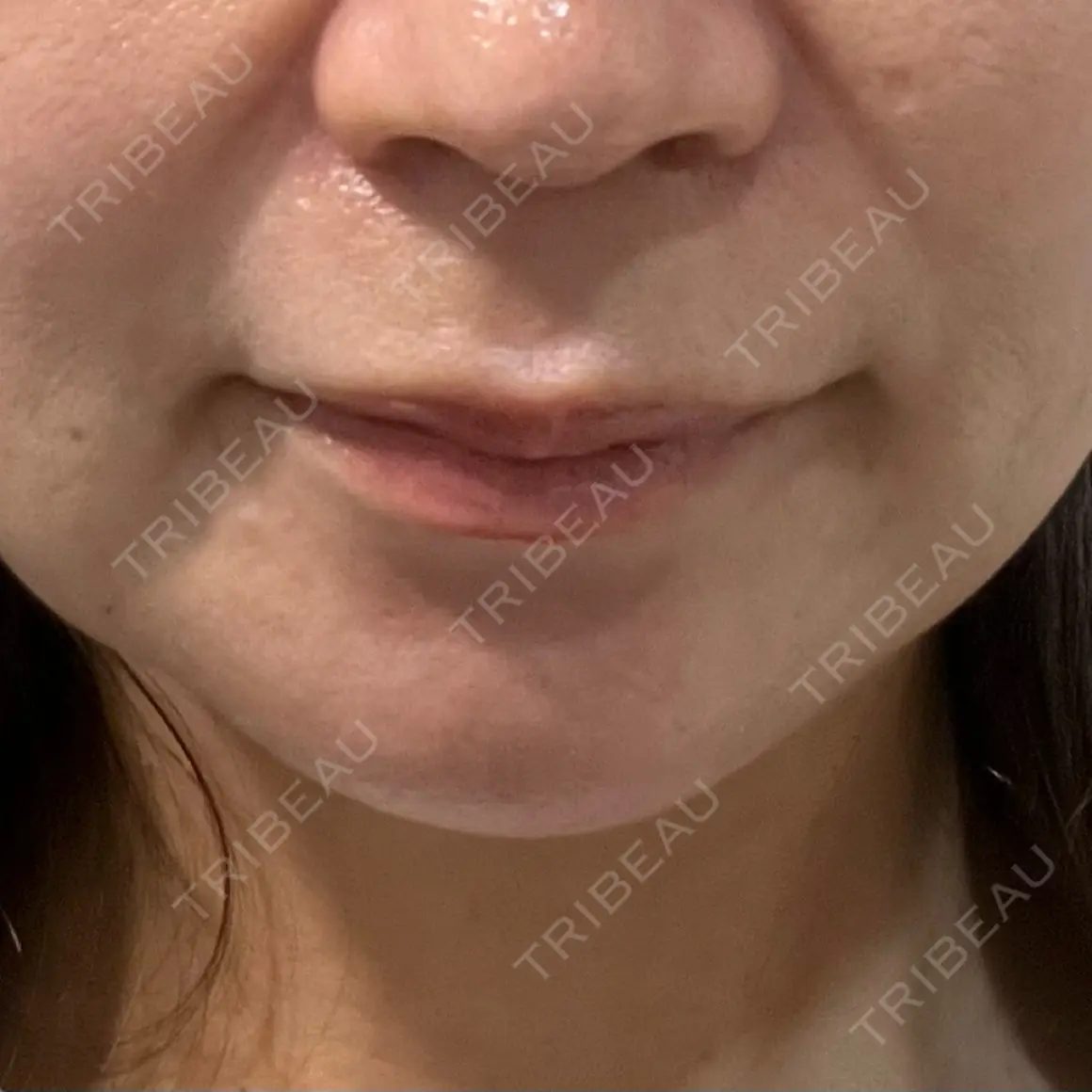 脂肪溶解注射（顔） LIF SKIN CLINIC AFTER