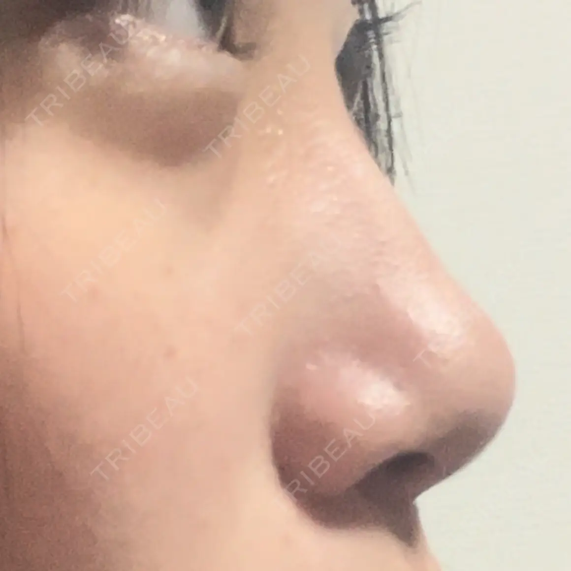 隆鼻術 / 鼻尖形成（切開） / 鼻中隔延長（切開） / 軟骨移植 / ワシ鼻修正・ハンプ切除 / 斜鼻修正 / 鼻尖縮小 東京シンデレラ美容外科 新宿院 AFTER