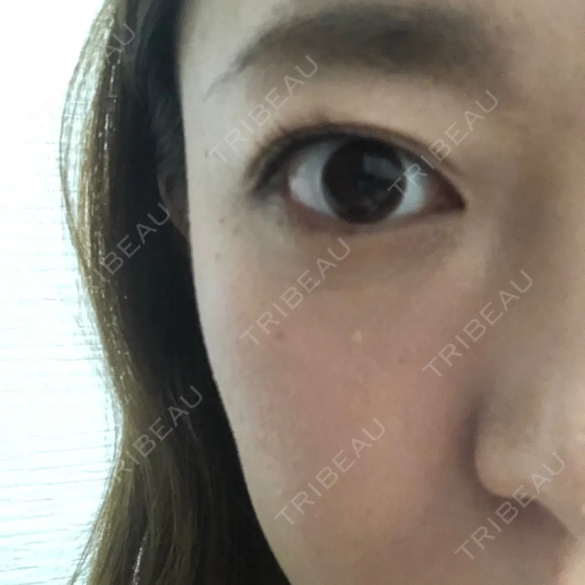 クマ治療 / 下まぶたの脂肪取り TCB東京中央美容外科 中野院 AFTER