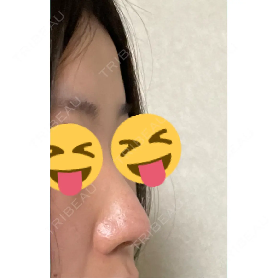隆鼻術 / 鼻尖形成（切開） / 小鼻縮小（切開） / 軟骨移植 / 鼻柱下降・鼻唇角形成（猫手術） / ヒアルロン酸注入（額） / ヒアルロン酸注入（こめかみ） グローバルビューティークリニック 大阪院 AFTER