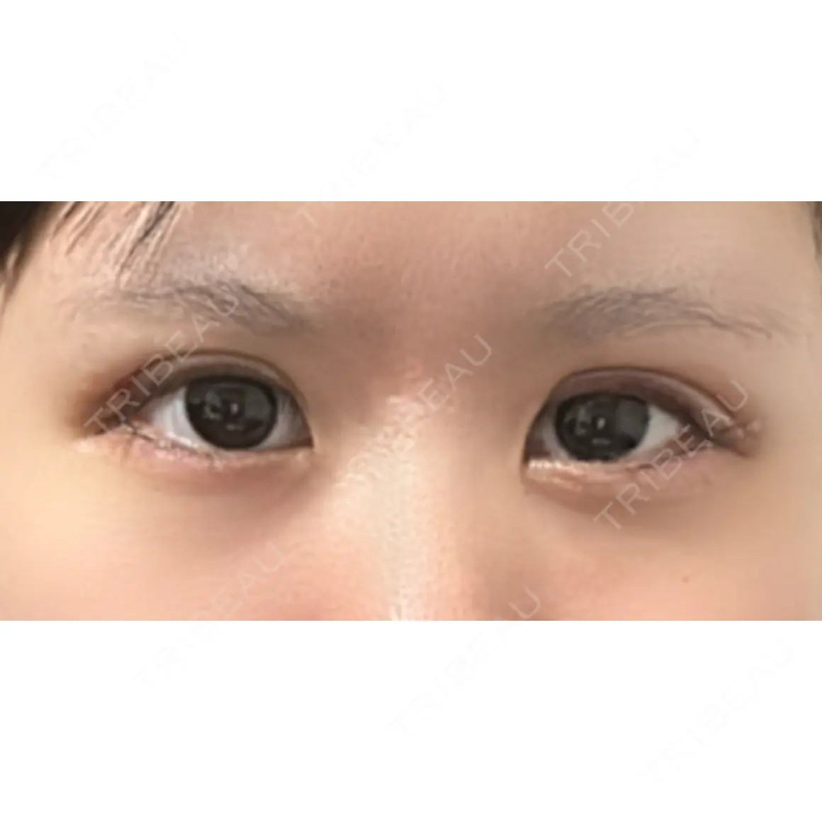 二重埋没 / 上まぶたの脂肪取り 湘南美容クリニック 西葛西院 AFTER