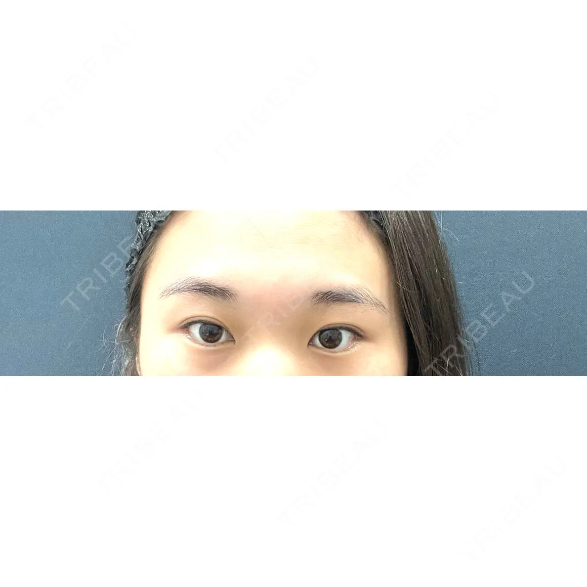 二重埋没 / 上まぶたの脂肪取り 湘南美容クリニック 西葛西院 AFTER