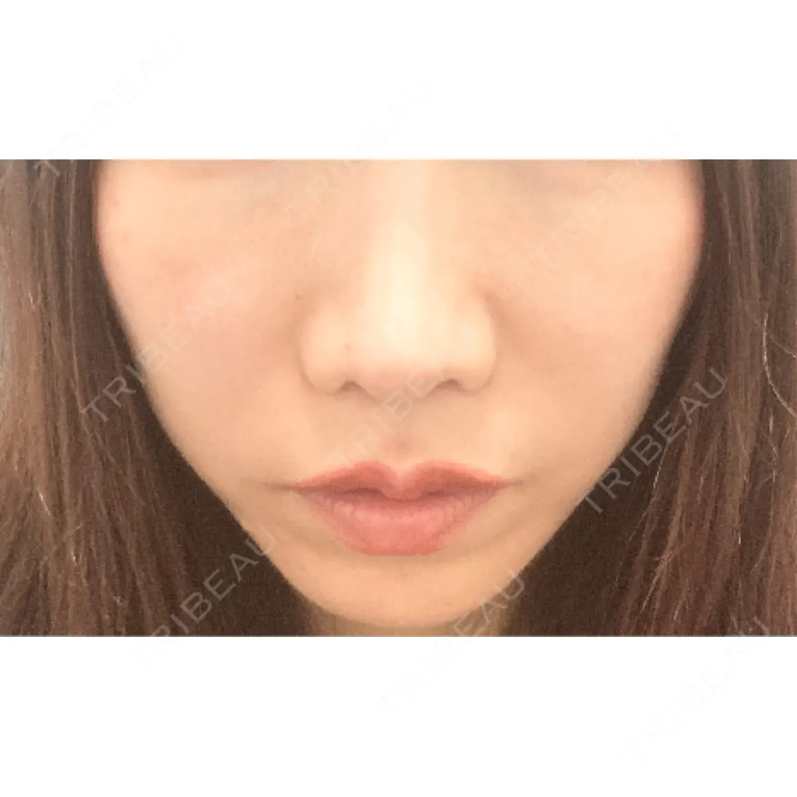 ヒアルロン酸注入（唇） / ボトックス（口角） おおたかの森ビューティークリニック AFTER