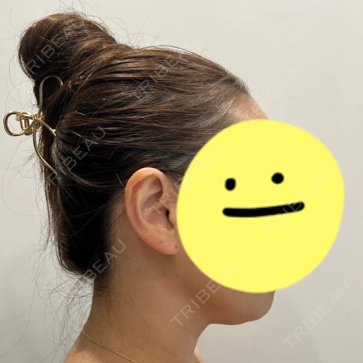 脂肪溶解注射（顔） / 脂肪溶解注射（二の腕） SK新宿歌舞伎町美容外科・歯科 AFTER