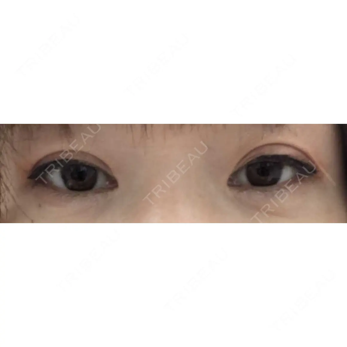 目頭切開 9BeautyClinic AFTER