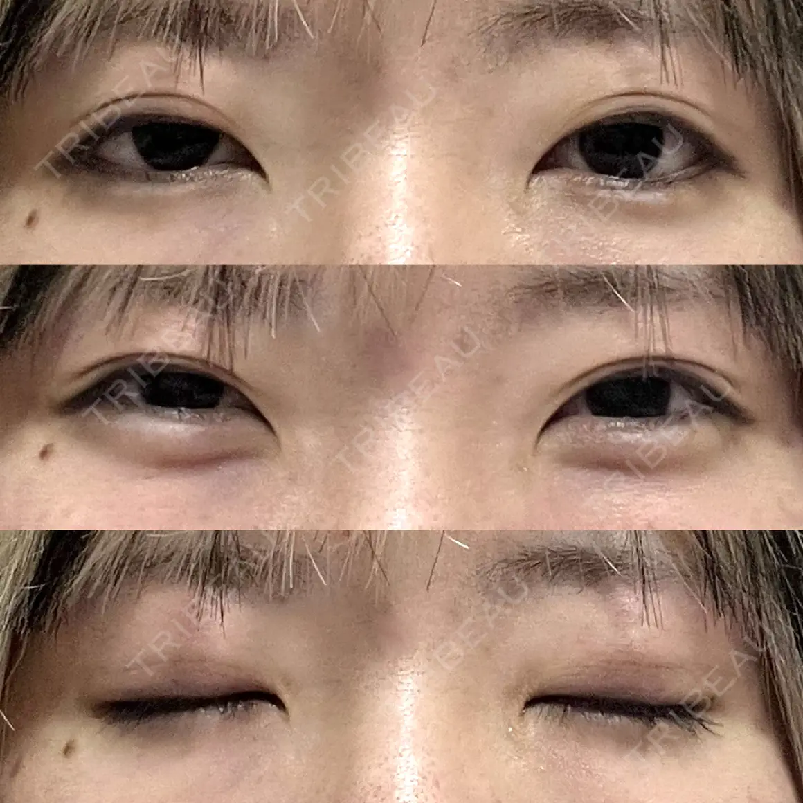 自然癒着法 プロミス整形外科 AFTER