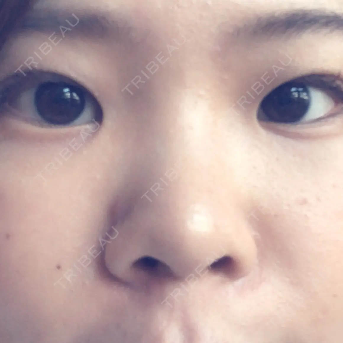 鼻尖形成（切開） / 鼻中隔延長（切開） / 小鼻縮小（切開） / 真皮移植 加美（GAMI）整形外科 AFTER