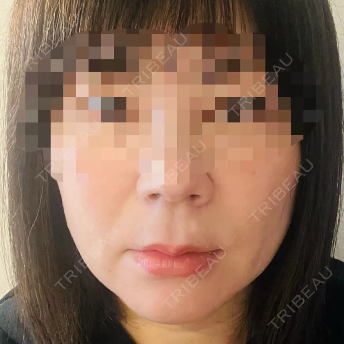 糸リフト 福岡TAクリニック AFTER