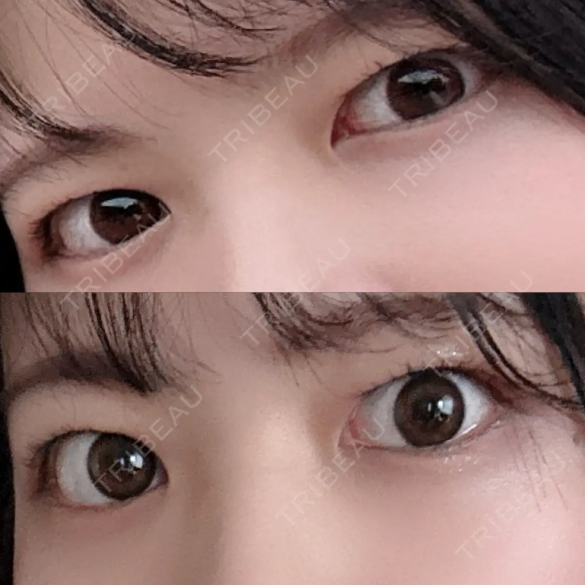二重埋没 湘南美容クリニック 西葛西院 AFTER