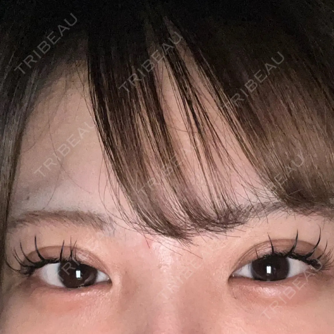 目頭切開 9BeautyClinic AFTER