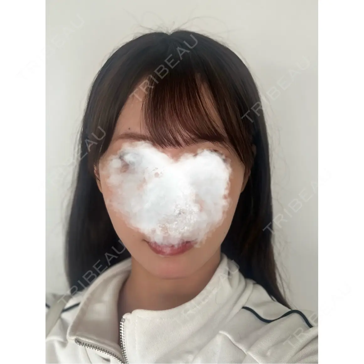 糸リフト X CLINIC 銀座院 AFTER