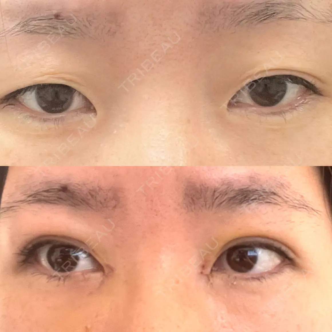 二重埋没 / 目頭切開 湘南美容クリニック 西葛西院 AFTER
