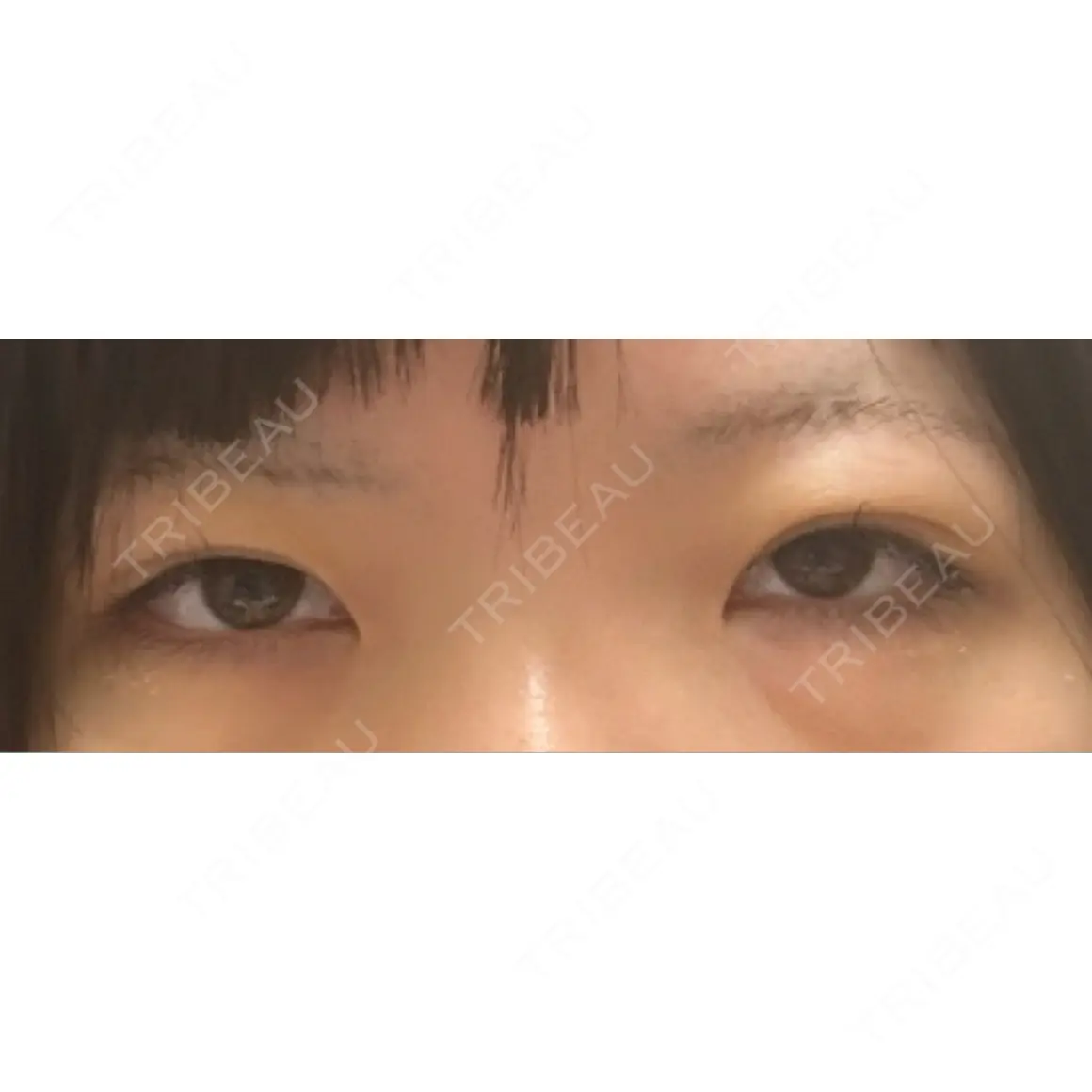 二重切開 / 目頭切開 / 眼瞼下垂（切開） / 上まぶたの脂肪取り オーキッド美容クリニック東京御徒町 AFTER