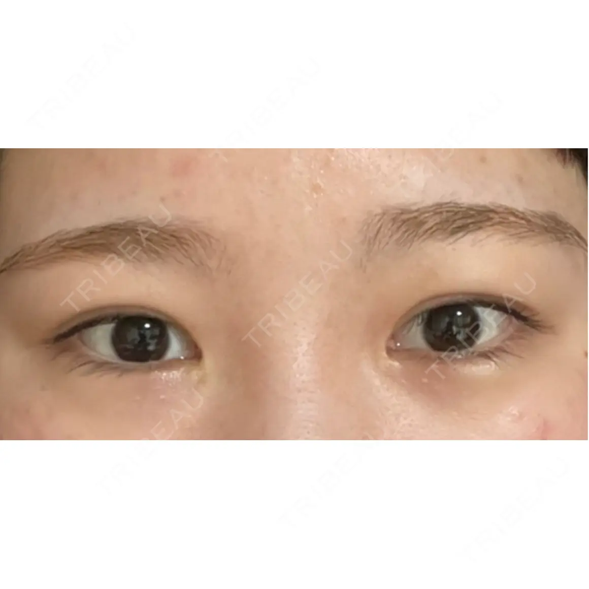 二重埋没 / タレ目形成・グラマラスライン（切開） エターナル美容クリニック AFTER