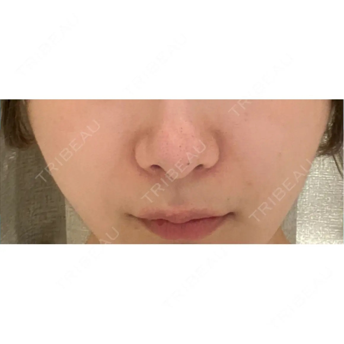 ヒアルロン酸注入（鼻翼基部） / 光治療（フォトフェイシャルなど） DMTC美容皮膚科 大宮院 AFTER