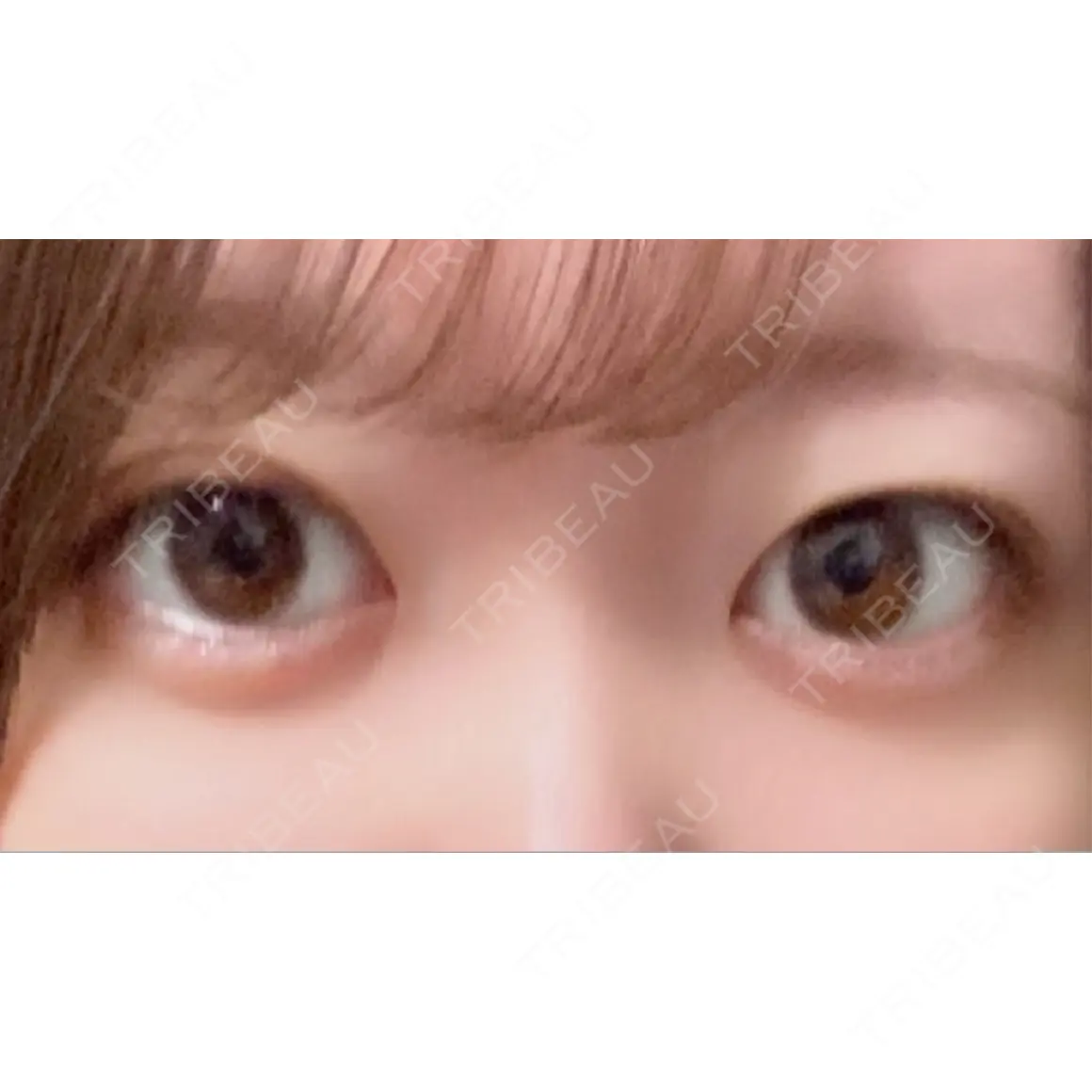 二重埋没 / 目頭切開 / 自然癒着法 Brandnew Beauty Clinic AFTER