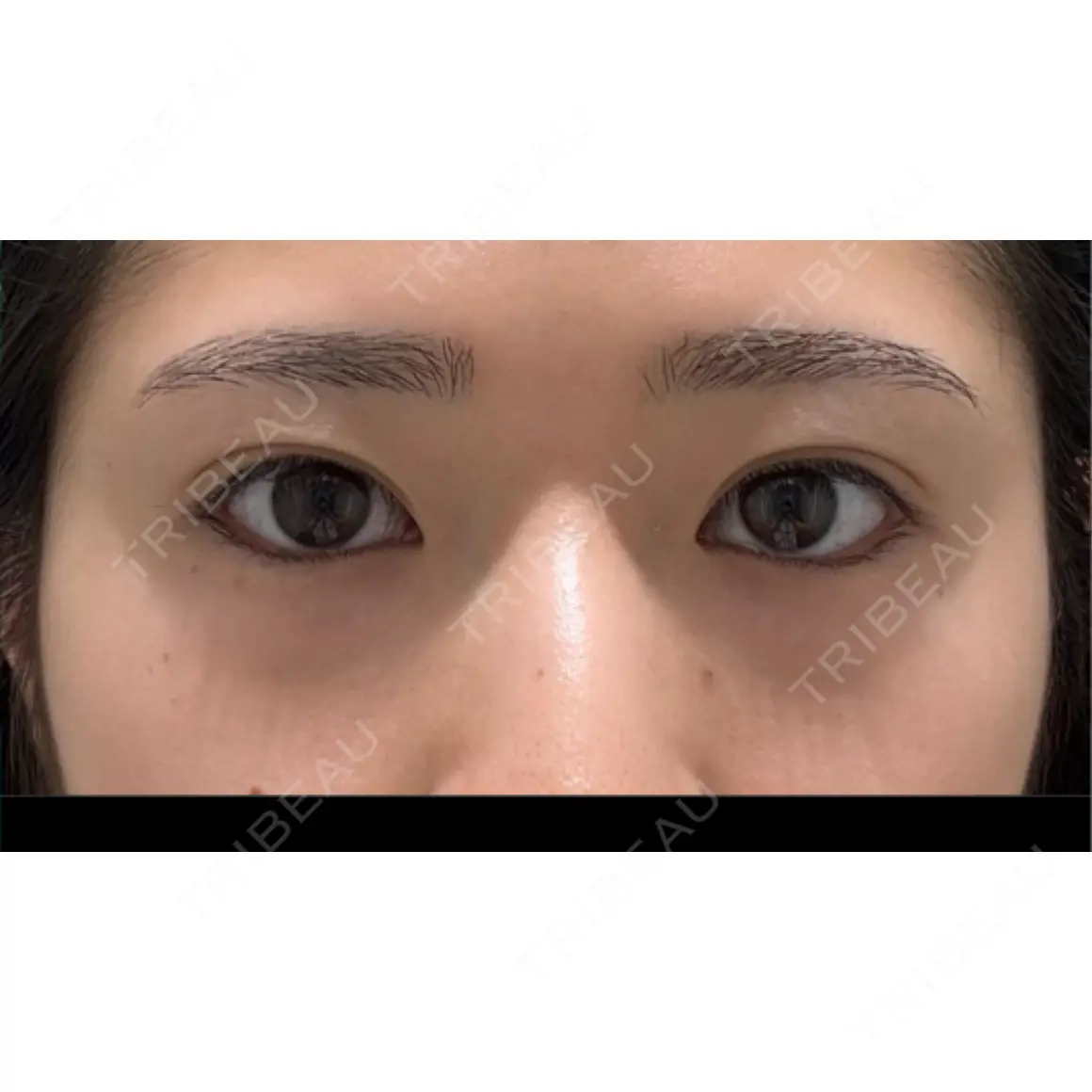 クマ治療 / 下まぶたの脂肪取り EMMO FACE CLINIC 東京三田院 AFTER