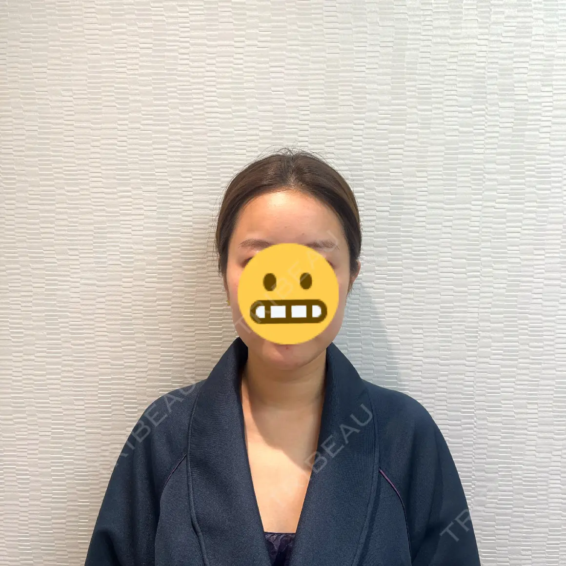 脂肪吸引（顔） Mods Clinic（モッズクリニック） 大阪院 AFTER
