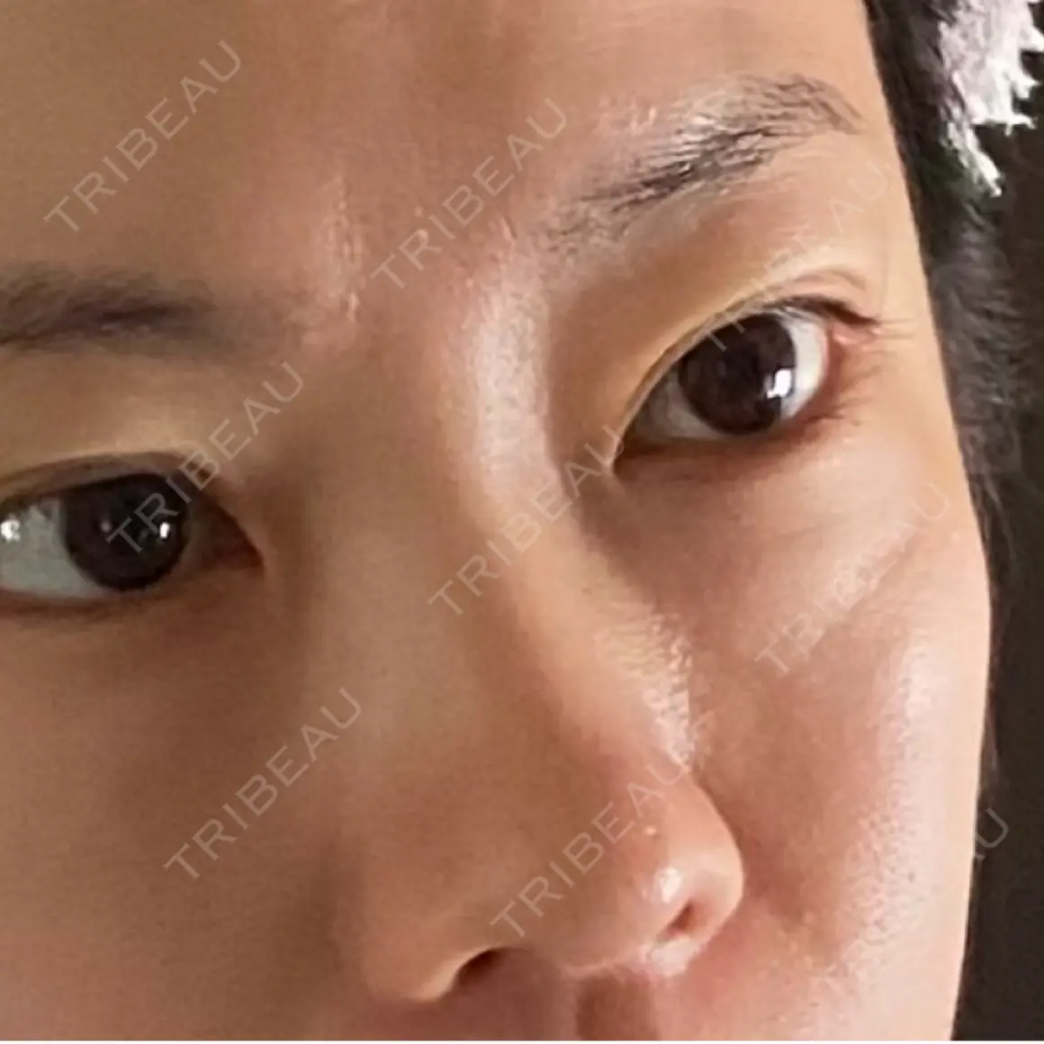 クマ治療 EMMO FACE CLINIC 東京三田院 AFTER