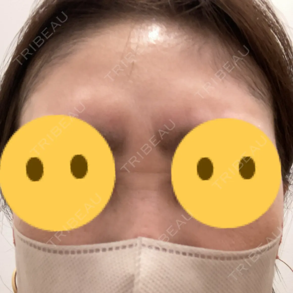ボトックス（眉間） PRO CLINIC プロクリニック 銀座院 AFTER