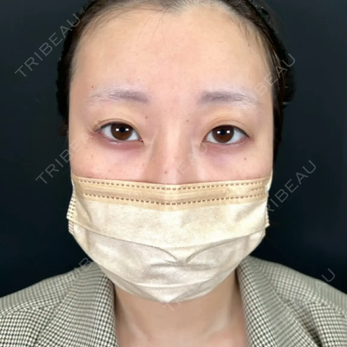 二重埋没 / 目頭切開 湘南美容クリニック 西葛西院 AFTER