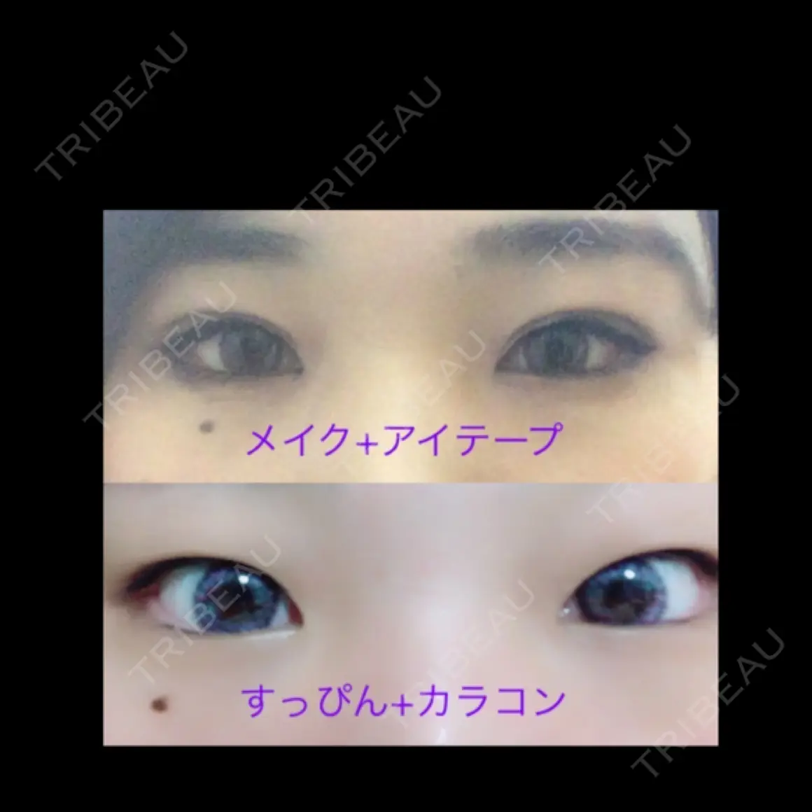 二重埋没 共立美容外科 渋谷院 AFTER