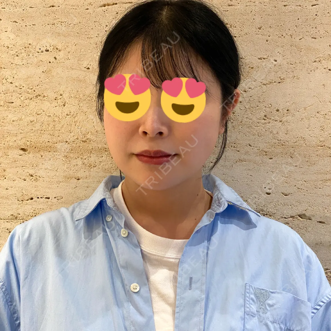 鼻尖形成（切開） / 脂肪吸引（顔） / 鼻孔縁下降 / あご下筋肉縛り / その他（鼻） LUHO（ルホ）美容外科 AFTER