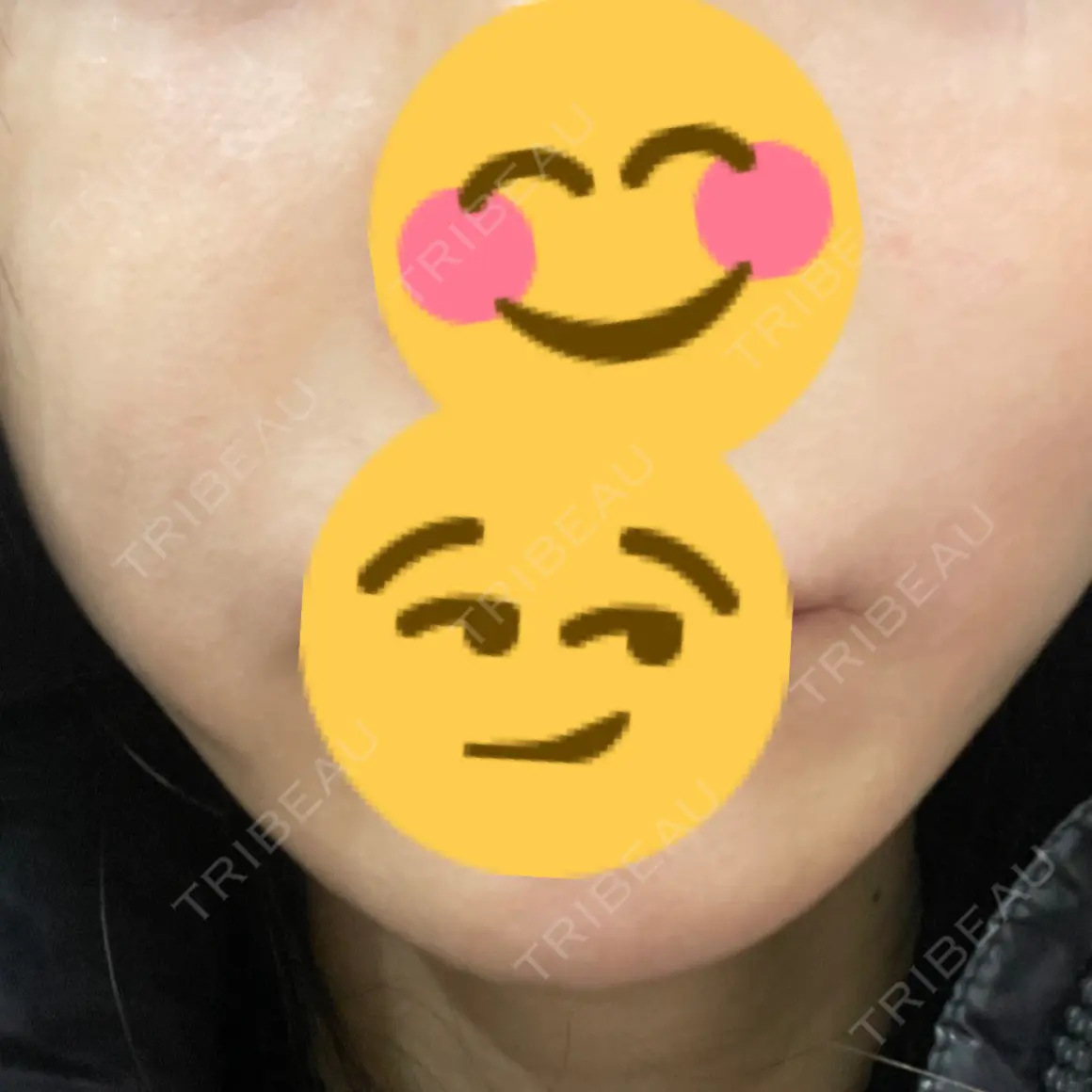 脂肪溶解注射（顔） AZ BEAUTY CLINIC AFTER