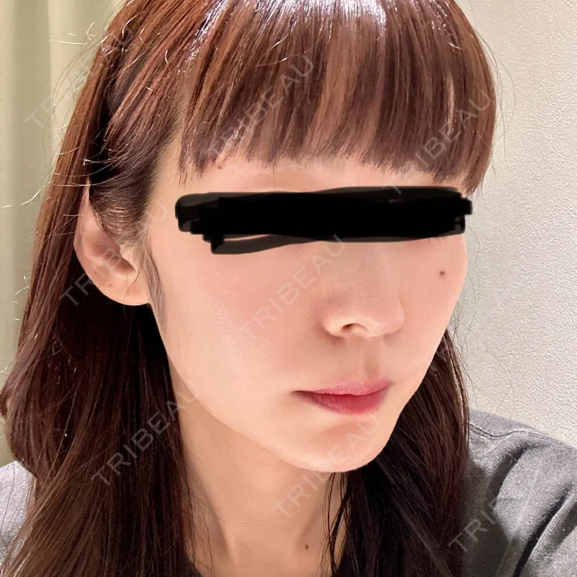 美肌レーザー / その他（輪郭） ビューティー和心クリニック 浅草院 AFTER
