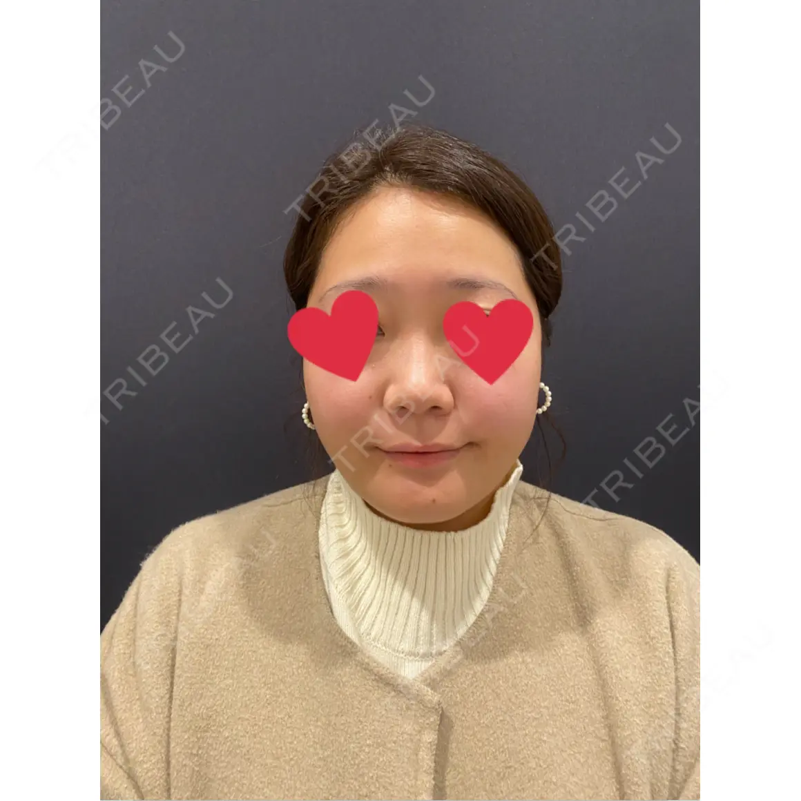 鼻尖形成（切開） / 眉間プロテーゼ / ヒアルロン酸注入（涙袋） / その他（鼻） YBC横浜美容外科 立川院 AFTER