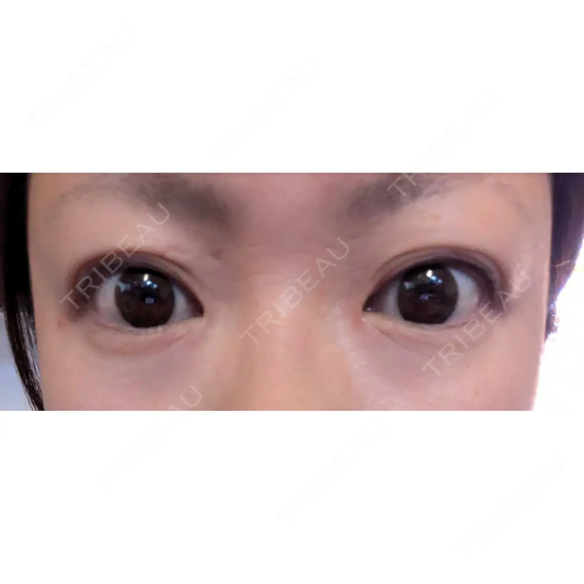 二重埋没 湘南美容クリニック 西葛西院 AFTER