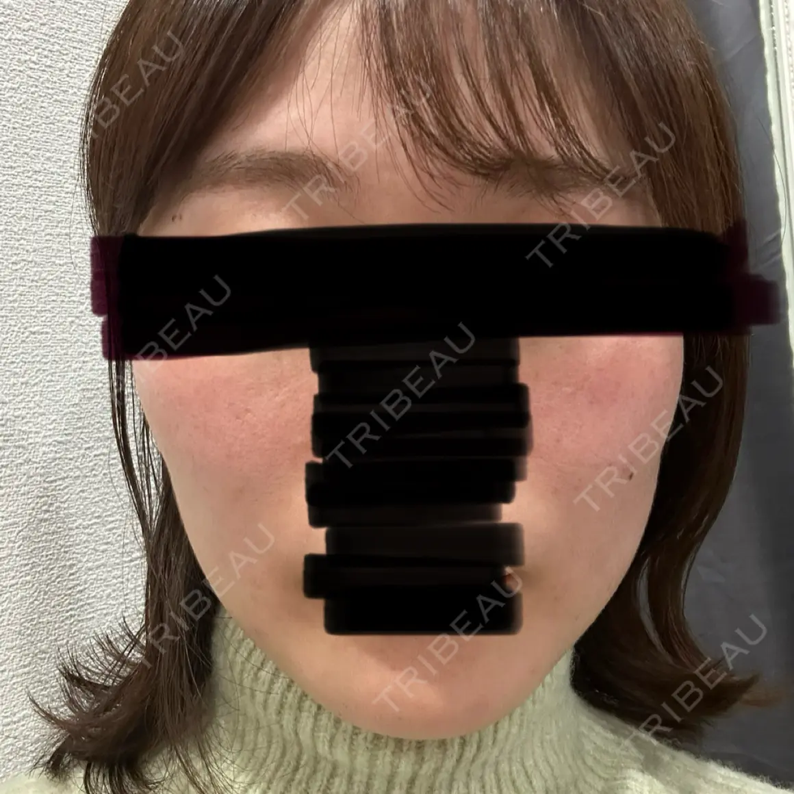 美肌レーザー / 医療脱毛（顔） / その他（輪郭） ビューティー和心クリニック 浅草院 AFTER